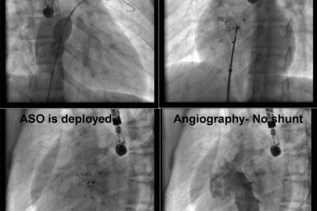 kardiologoi-peiraia - ASD II Occlusion