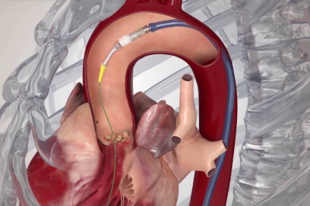 kardiologoi-peiraia - TAVI (3)