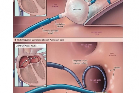 kardiologoi-peiraia Αρρυθμίες (3)