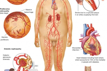 kardiologoi-peiraia - Μεταβολικό σύνδρομο