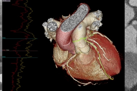 kardiologoi-peiraia - CCTA (1)