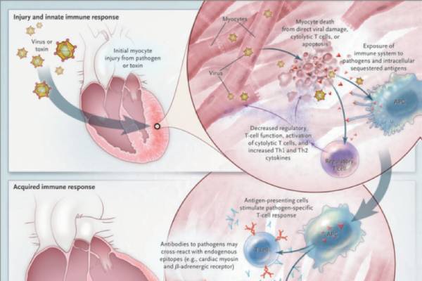 kardiologoi-peiraia - Μυοκαρδίτιδα και περικαρδίτιδα